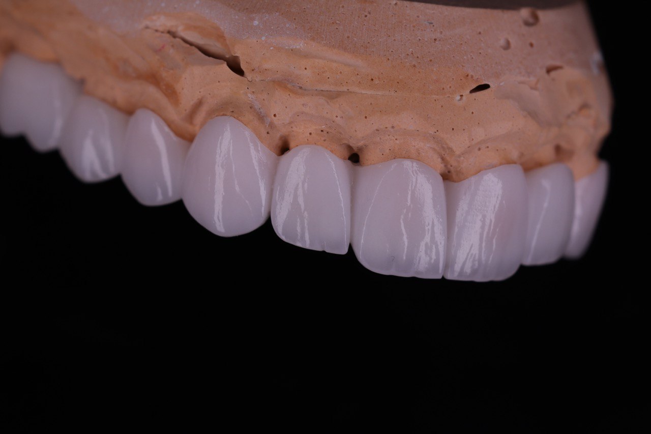 Zirconia Bridges